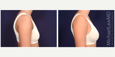25-34 year old woman treated with Sientra Breast Implants - Breast augmentation. Follow-up photos taken 6 months after the procedure.