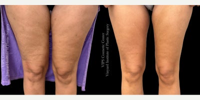 35-44 year old woman treated with Skin Rejuvenation, Microneedling RF, Morpheus8, Microneedling, Skin Tightening - This 3544-year-old woman underwent a series of Morpheus8 BODY treatments on the thighs to address skin laxity, cellulite, and crepey texture that had developed over time. She was frustrated by the early signs of aging and loss of firmness in her inner and front thighs. Morpheus8 BODY uses advanced radiofrequency microneedling technology to stimulate deep collagen production, tighten the skin, and provide mild fat reduction by targeting subdermal layers. The result was visibly smoother, firmer, and more contoured thighs with improved texture and definition. This non-surgical treatment gave her the confidence boost she was looking forand she is thrilled with her results.