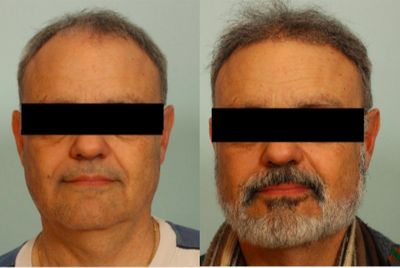 55-64 year old man treated with Hair Transplant - Hair Transplant