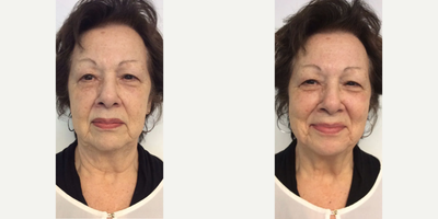 Woman treated with DiamondGlow - Woman treated with DiamondGlow