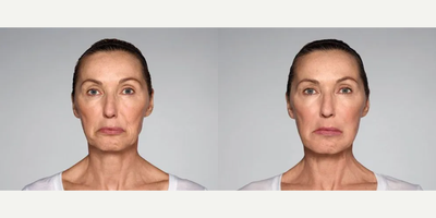 Woman treated with Restylane Refyne - 1.5 mL Restylane Refyne in nasolabial folds1.0 mL Restylane Refyne in marionette linesPhotos taken before treatment and 2 weeks after treatment