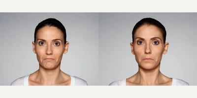 Woman treated with Restylane Defyne - 1.0 mL Restylane Defyne in nasolabial folds1.0 mL Restylane Defyne in marionette linesPhotos taken before treatment and 2 weeks after treatment