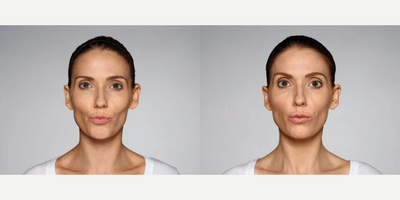 Woman treated with Restylane Defyne - 1.0 mL Restylane Defyne in nasolabial folds1.0 mL Restylane Defyne in marionette linesPhotos taken before treatment and 2 weeks after treatment