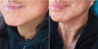 35-44 year old woman treated with Skintyte - What exactly is SkinTyte?SkinTyte is a pulsed light technology that heats deep within the skin while protecting and cooling the surface. The laser is able to accomplish this via selective thermolysis. Best of all, there is absolutely no down time.What areas can be treated?Any area of the body where an improvement to the tightness of the skin is desired can be treated.What Does SkinTyte Improve? Tightens and improves the texture and smoothness of your skin Stimulates collagen production in your skin for continued skin tightening over time Plumps and adds volume to the skin Reduces fine lines and some wrinkles around the mouth, lips and eyes Improves the definition of your jawline