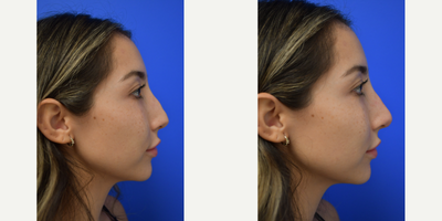 25-34 year old woman treated with Rhinoplasty, Restylane - This patient had a chemical rhinoplasty using Restylane. You can see the difference immediately with no down time!!
