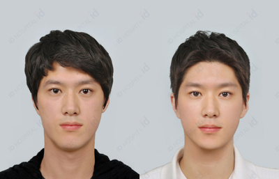 25-34 year old man treated with V Line Surgery - Male Orthognatic Surgery + Mouth Protrusion Surgery