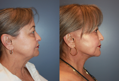 55-64 year old woman treated with Facelift - Facelift, Upper and Lower Eyelid Blepharoplasty