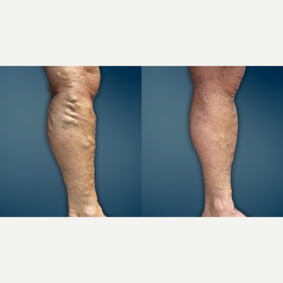 35-44 year old woman treated with EVLT - This very sweet 40 year old mother of three had suffered from painful varicose veins and leg swelling for 15 years. After undergoing one EVLT procedure as well as a micro-phlebectomy she was back to hiking and wearing shorts.