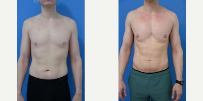 35-44 year old man treated with Pec Implants, Liposculpture, Liposuction - 33 year old male over 4 months after custom pectoral implants, liposuction and fat transfer to his trapezius and deltoids muscles performed by Dr Sam Gershenbaum. He had custom extended vertical rectangular pec implants placed under the muscle. He also had liposuction of his abdomen and waist with fat transfer to his trapezius and deltoid muscles. His change is dramatic. His abdomen and waist are well contoured and fit and the elevation and curves of the fat transfer to his traps and deltoids add well to the overall muscular shape. He looks fit, muscular contoured and very natural. He is extremely happy with his results.