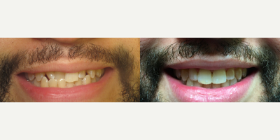 25-34 year old man treated with Six Month Smiles - Patient was not happy with smile and bite. This result was achieved in 6 months using cosmetic braces.