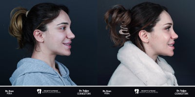 25-34 year old woman treated with Jaw Surgery, Genioplasty, V Line Surgery - Double jaw surgery is performed to correct the misalignment between the upper and lower jaws, balance facial aesthetics, and address functional issues such as chewing and speaking difficulties. The remarkable aesthetic and functional transformation of our patient once again proves the importance of meticulous planning and expert execution.