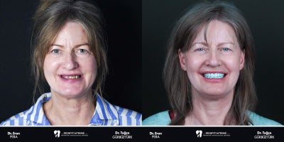 45-54 year old woman treated with Dental Implants - Zygomatic, Pterygoid and All on six implant treatment was performed by Dr. Eren Pera.