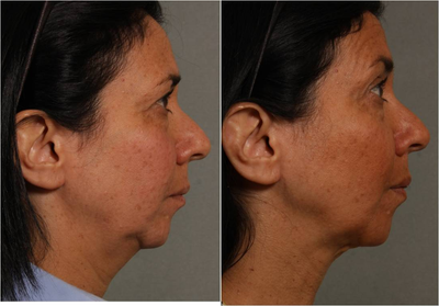 51 year old female with neck and jaw line skin laxity who wants noticeable results without invasive surgery.   - 
	Before: 51 year old female who presents with early jowls and neck laxity. This is due to loss of skin elasticity and also loss of volume along her jaw line in the pre jowl region. Patient doesnt feel she is ready for a neck lift or face lift. Also prefer to have little to now downtime yet she wants noticeable results. After: 6 months after Precision Tx, a new type of Smart Lipo where the laser primarily tightens the skin with very little fat reduction. This is ideal for patients like this one, who has very little excess fat along the jaw line and neck. Her issue is loss of skin elasticity, not excess fat in her jowls and neck. Note dramatic improvement in neck and jaw line contours.