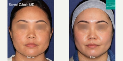 Picoway Laser to Treat Brown Spots by Dr. Zubair - Picoway Laser to Treat Brown Spots by Dr. Zubair