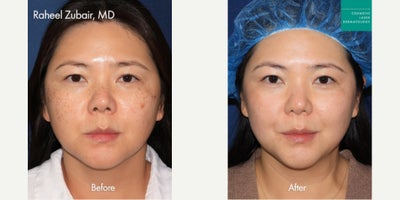 Fraxel and Alexandrite Lasers to Treat Sun Damage by Dr. Zubair - Fraxel and Alexandrite Lasers to Treat Sun Damage by Dr. Zubair