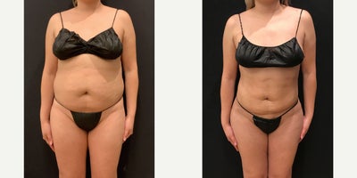 25-34 year old woman treated with Brazilian Butt Lift - Brazilian Butt Lift - Liposuction with fat transfer to buttocks and hips