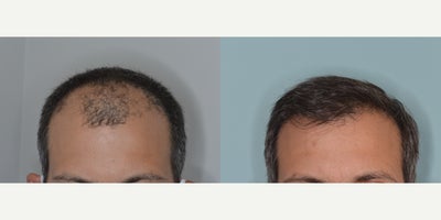 35-44 year old man treated with FUE Hair Transplant - 40 year old male.  Before and After 2,200 FUE grafts to restore frontal hair loss.
