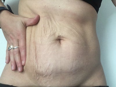 HIFU Tummy Tightening - Results In Progress! 🩵⁠ ⁠ HIFU works to