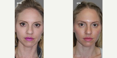 35-44 year old woman treated with Botox, Cheek Augmentation, Cheek Fillers, Chin Filler, Chemical Peel, Dermal Fillers, Lip Fill - This beautiful patient came to me wanting a refreshed, natural look without surgery. She had previously received under-eye filler from another provider that left her looking uneven, so I first dissolved the old product and carefully reinjected with precision.Her customized treatment included:* Botox - from the forehead down to the chin - for a brighter, more relaxed look. * Filler - from the undereyes down to the chin - to restore balance and harmony. * Chin and jaw refinement for improved profile and facial proportions.* Chemical peel to smooth and rejuvenate skin texture and tone.The result? A radiant, natural-looking rejuvenation. Her eyes appear more open and refreshed, her midface and lips are softly enhanced, and her overall facial balance is restored - all while maintaining her natural beauty.