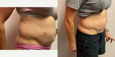 35-44 year old woman treated with Cryoskin - Cryoskin body contouring for slimming and toning! 4/5 treatments!