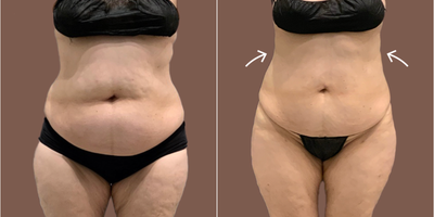Woman treated with AirSculpt - Woman treated with AirSculpt