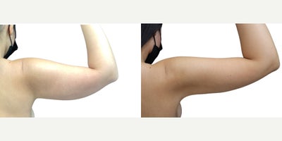 Woman treated with Arm Lift, Liposuction, Breast Augmentation - Woman treated with Arm Lift, Liposuction, Breast Augmentation