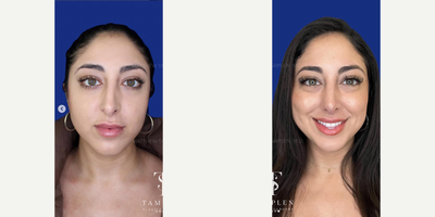 Woman treated with Revision Rhinoplasty - Just 6 weeks after Revision Rhinoplasty and this patient is feeling and breathing so much better!She had her first rhinoplasty by another surgeon and all though he made her nose smaller, without a straight foundation, this lead to severe deviation and nasal obstruction, valve collapse and a hanging columella.My Revision Rhinoplasty with my signature tip support technique was able to correct all of her issues - and now, she could not be happier with her nose and says this is the nose Ive always wanted.Elegant, natural and open airways. This is what its all about!