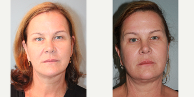 62 year old woman treated with Quick Lift - The doctor performed his exclusive LiteLift modififed facelift which is lighter on incisions, anesthesia (local was used) and recovery. He also performed neck lipo to reduce fullness followed by a platysmaplasty to reduce visibility of neck banding. After surgery, notice the improvement in her lower neck area. After photos were taken 2 years post-op.