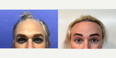 Patient treated with Brow Lift, Chemical Peel, Hair Transplant, Mole Removal, TCA Peel - 35 to 44 year-old female patient is 2 years post-op from Facial Feminization surgery. Her procedures included: Placement of Tissue Expander for Mayer Flap, Forehead Lift and Orbital Bony Contouring, Septorhinoplasty (closed) with Cartilage Grafts and Weirs, Cheek Implants (small), Chin Reduction and Contour, Subnasal Lip Lift with Fat Augmentation to Lips, Medium Facelift, 1cc Voluma and Juvederm, Periorbital TCA, and mole removals on face. Patient is 1.5 years post-op from Removal of Tissue Expander and Rotate Flap. Patient is 3 months post-op from Dog Ear Procedure, and 800 Micrografts to Hairline.