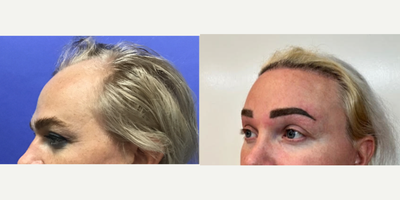Patient treated with Brow Lift, Chemical Peel, Hair Transplant, Mole Removal, TCA Peel - 35 to 44 year-old female patient is 2 years post-op from Facial Feminization surgery. Her procedures included: Placement of Tissue Expander for Mayer Flap, Forehead Lift and Orbital Bony Contouring, Septorhinoplasty (closed) with Cartilage Grafts and Weirs, Cheek Implants (small), Chin Reduction and Contour, Subnasal Lip Lift with Fat Augmentation to Lips, Medium Facelift, 1cc Voluma and Juvederm, Periorbital TCA, and mole removals on face. Patient is 1.5 years post-op from Removal of Tissue Expander and Rotate Flap. Patient is 3 months post-op from Dog Ear Procedure, and 800 Micrografts to Hairline.