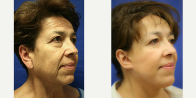 Ear Lobe Surgery (side view L) - This is a 61 year old female. She was not happy with the appearance of her face or neck. She underwent a face lift, neck lift, brow lift, upper and lower blepharoplasty and earlobe reduction.