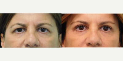 45-54 year old woman treated with Brow Lift and Upper Eyelid Lift - This young woman presented with the desire to improve her droopy eyelids and eyebrows. She complained that she felt her eyes looked always tired and depressed. Examination revealed and excess of upper eyelid thin skin along with drooping eyebrows (especially laterally/towards the ears). Together we decided to perform an upper blepharoplasty (eyelid lift) to remove the excess thin skin above her eyelids, as well as a lateral brow lift to open the outer corners of her eyes. We performed both procedures on the same day in the comfort of our Center under local anesthesia and oral sedation with valium. Her recovery time was approximately one week (when her stitches were removed). Her final result demonstrates a bright-eyed appearance without appearing unnatural.