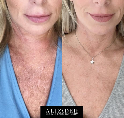 Woman treated with BroadBand Light (BBL) - Woman treated with BroadBand Light (BBL) and Sciton Halo for years of sun damage on the chest. Laser and broadband light energy combined can help with the wrinkles, discoloration, and other unwanted results of sun exposure.