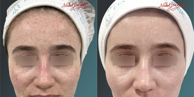 25-34 Years Old Woman Treated with PicoSure - The transformation of our patient, who got rid of from the spots on her face and forehead areas; after the treatment process, is attached.