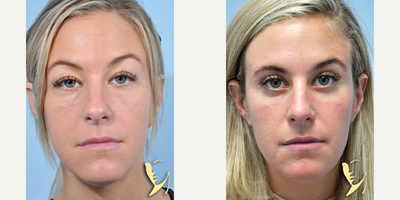 25-34 year old woman treated with Double Eyelid Surgery - Eyelid Surgery (Upper & Lower Blepharoplasty) by Burke Robinson, MD, FACS