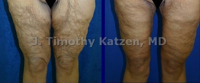 Leg Lift after weight loss surgery - This patient had a thigh lift after massive weight loss surgery. - Individual Results May Vary