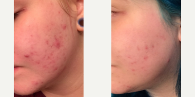 18-24 year old woman treated with Skin Rejuvenation - Patient has been using Neocutis medical grade skin care only.
