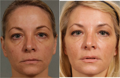 47 year old female treated for loss of volume under eyes, cheeks, and lips - 
	Before: age 47. Note tiredness around eyes in part due to puffiness of the lower lids and loss of volume around the eyes and cheeks. There is the appearance of a sadness as a result of her lips and corner of mouth being down turned. Her lips have also thinned out with age. After: 1 syringe of Restylane was used to fill the patients tear trough making the puffiness around her eyes less apparent. 1 Syringe of Radiesse was used to fill her sunken cheeks and lift her mid face upward. 1 syringe of Juvederm to fill in the patients marionette lines and lift the corner of the mouth upward. A little Juvederm was used to restore lost lip volume. This was aided by the use of Botox injection to weaken the muscle that pulls down the lips. Patient has less tired, less sad appearance with a refreshed look. No downtime. Results will last up to a year.
