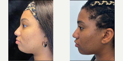 25-34 year old woman treated with Nonsurgical Facelift, Facial, Evolve - Evoke Treatment with Facial - treated by Alyssa Gutierrez