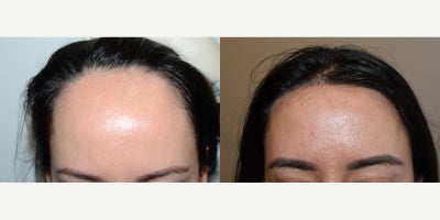 25-34 year old woman treated with Forehead Reduction - Result of hairline lowering/forehead reduction surgery. This 27yo female shown before and 3 months after hairline lowering surgery.