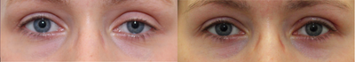 Ptosis surgery for left eyelid droop - She underwent ptosis surgery with Dr. Kotlus to correct a droopy left upper eyelid.