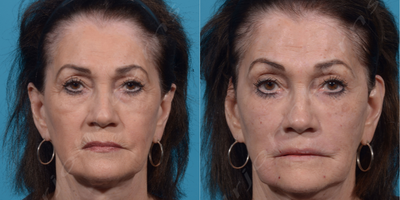 65-74 year old woman treated with Liquid Facelift - Liquid facelift:Botox: glabella, forehead, crows feetMidface: VolumaNasolabial folds/Marionette lines: VollureLip Lines: VolbellaSkin Resurfacing: Microneedling with PRP and AquaGold microbotox