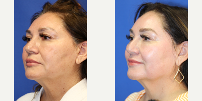 55-64 year old woman treated with Chemical Peel - This is a 57 year old Hispanic patient who was not happy with the uneven skin coloring, fine lines, and dark spots in her face. She had a chemical peel with Dr. J. Timothy Katzen in Beverly Hills, CA.  Notice the improvement in her skin, improved fine lines and dark spots.