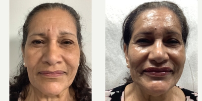 75 and up year old woman treated with Dermal Fillers, RHA Collection Fillers, Liquid Facelift, Cheek Fillers, Lip Fillers - Patient had rha 4 and rha 3 done in her cheeks, nasiolabial, lips she applied my compounded hyaluronic acid/green tea serum to her face