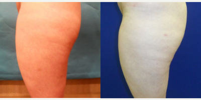 Woman treated with Cellulaze - Woman treated with Cellulaze