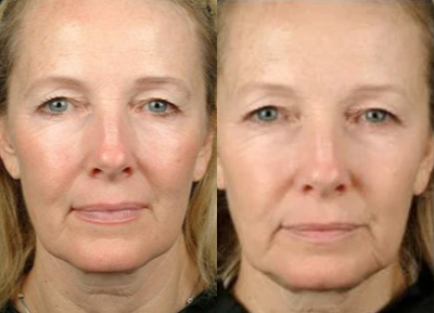 45-54 year old woman treated with Thermage - 3 months after Thermage treatment