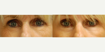 55-64 year old man treated with Phenol Peel - Deep wrinkles in the skin that do not go away when the skin is stretched result from a combination of lifelong sun damage and repetitive facial movements. In these cases, a skin resurfacing treatment is most effective because it removes the top layer of skin and allows new baby skin to grow in its place.