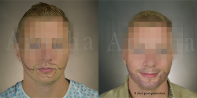 Beard Transplant - FUE - 23-year-old young man with scant facial hair growth wanted to have a full beard restoration. We performed an FUE procedure of about 2500 grafts. The after images are labeled immediately following the procedure, three-days after the procedure and eight-days after the procedure.