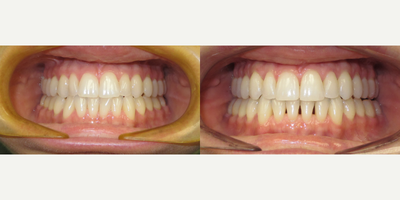25-34 year old woman treated with AcceleDent - Overbite, crowding, Invisalign treatment. Original estimated treatment time: 18-24 months. With AcceleDent, the case was finished in 12 months.