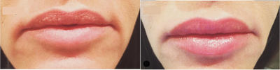Woman treated with Ultherapy - Woman treated with Ultherapy